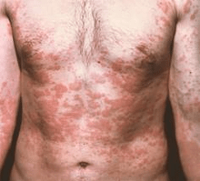 La piel problemática es un síntoma de la presencia de parásitos.