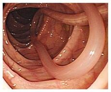 parásitos en el cuerpo humano