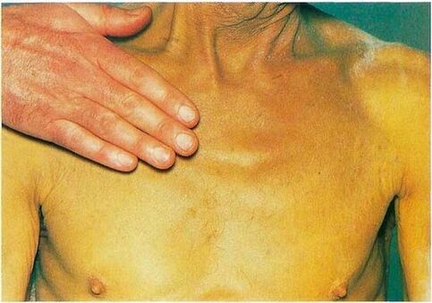 Ictericia debido a parásitos en el cuerpo.