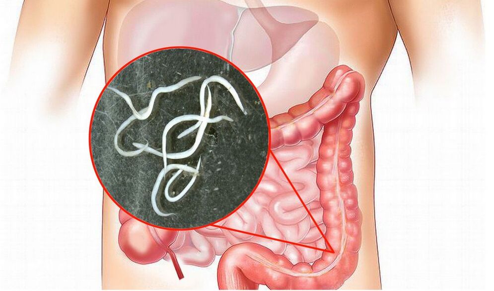 gusanos en los intestinos