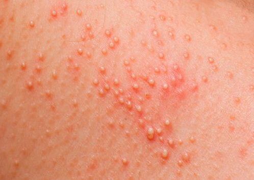 Si el cuerpo se ve afectado por parásitos, aparece una alergia cutánea. 