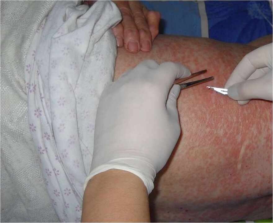 Raspado del área afectada para detectar parásitos debajo de la piel. 