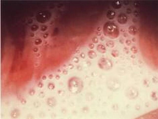 secreción de burbujas con parásitos protozoarios