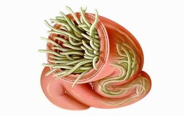 gusanos en el intestino humano foto 1