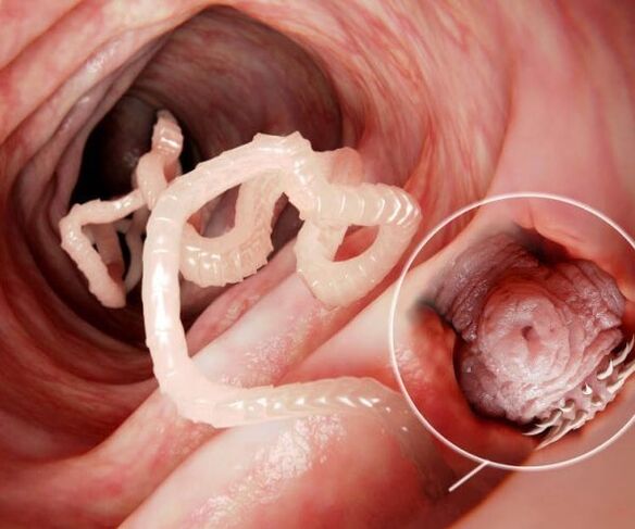 gusanos en el intestino humano foto 2